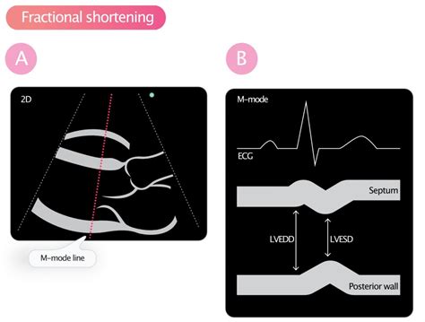 lv wall segments on echo|ejection fraction vs fractional shortening.